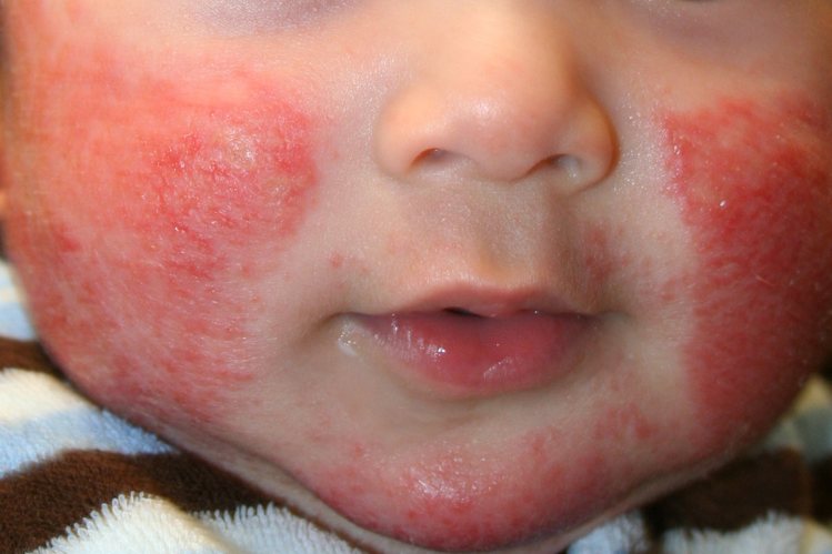 बच्चों की त्वचा पे एक्जीमा का घरेलु इलाज